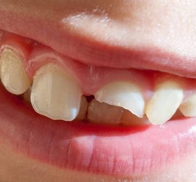 Close-up of a smiling mouth with uneven teeth, the artwork for Swimming Paul's album "Smiling Through the Pain 3"