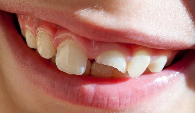 Close-up of a smiling mouth with uneven teeth, the artwork for Swimming Paul's album "Smiling Through the Pain 3"